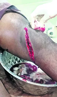 కోడికత్తి తగిలి ముగ్గురికి గాయాలు 