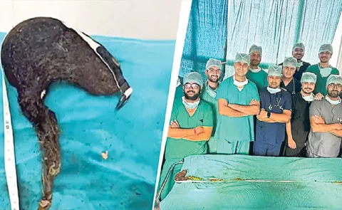 Jaipur doctors removed the world longest hairball from teen girl stomach