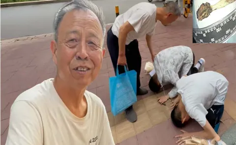 52 Years China Man Lived Toothbrush in Intestine After Swallowing At Age 1213