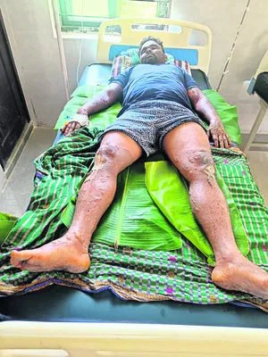 గ్యాస్‌ లీకై పెళ్లింట్లో ప్రమాదం 