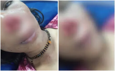 Man Bites Wife Nose Off During Fight Over Repaying Loan In Karnataka