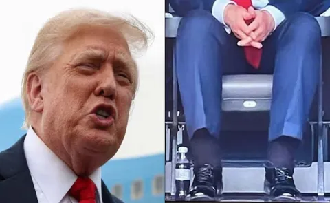 Donald Trump Has Chronic Venous Insufficiency: Signs Symptoms Risk Factors