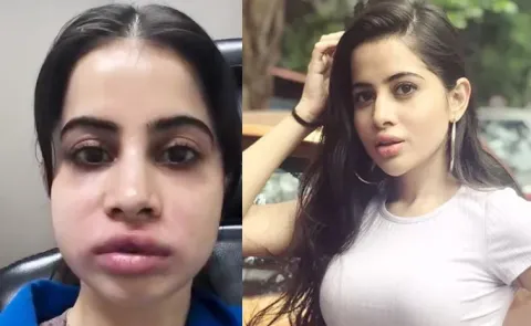 Actress Urfi Javed Face Swollen