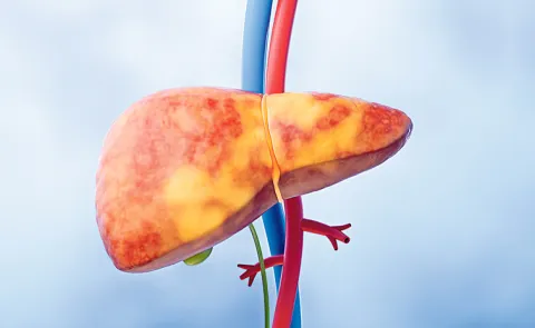 Most Of The IT Employees Struggle With Fatty Liver problem