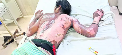 గ్యాస్‌ సిలిండర్‌ లీకేజీ●