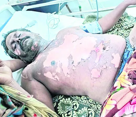 పిడుగుపాటుతో రైతుకు గాయాలు