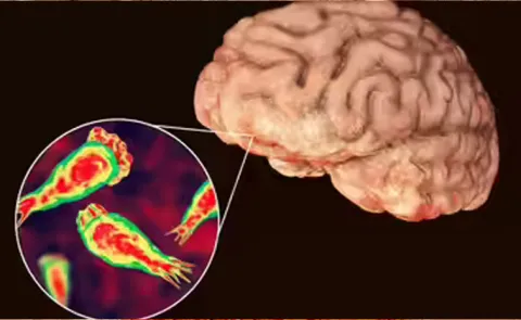 Brain Eating Amoeba Kills 19 in Kerala8