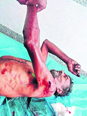 ఎలుగుబంట్ల దాడిలో   కాపరికి తీవ్ర గాయాలు 
