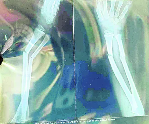 చేయి విరిగినా..  చలించలేదు! 
