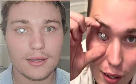 Slater Jones has fitted his artificial eye with a two carat diamond