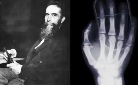 do you know Roentgen (X-ray) the discovery of Wilhelm Conrad Roentgen