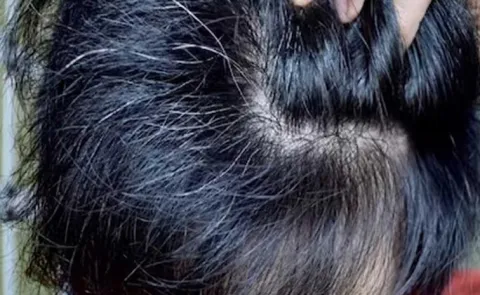 Graying Hair May Reflect a Natural Defense Against Cancer Risk