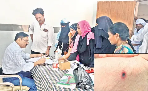 Rising cases of scrub typhus disease in Andhra Pradesh