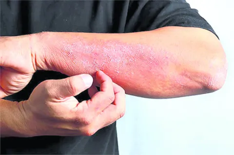 ● సొంత వైద్యంతో సమస్య జఠిలం ● జాగ్రత్తలు తీసుకుంటే వ్యా