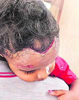 వీధి కుక్క దాడిలో బాలుడికి తీవ్ర గాయాలు 