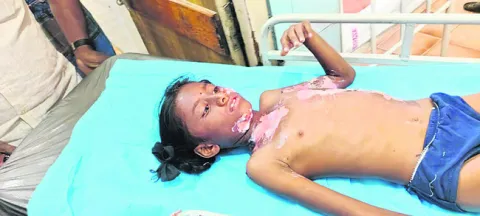 కరెంట్‌ షాక్‌తో బాలికకు తీవ్రగాయాలు