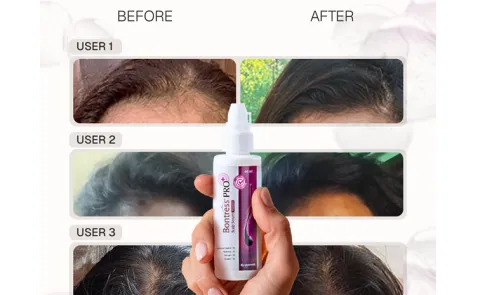 Bontress Pro+: The Science Backed Solution to Stop Hair Fall