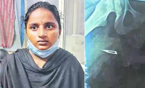  Doctor Forgotten Surgical Blade in Patient Thigh