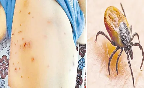 Nine Suspected Scrub Typhus deaths: Andhra Pradesh