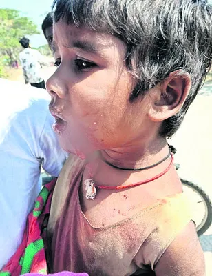 చిన్నారిపై వీధికుక్క దాడి 