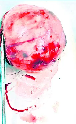 పామిడి సీహెచ్‌సీలో  అరుదైన శస్త్రచికిత్స 