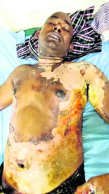 ఆత్మహత్యాయత్నం కాదు.. నిప్పంటించారు..! 