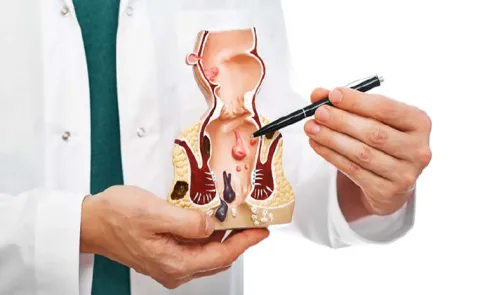 Hemorrhoids: Symptoms Causes And Treatment