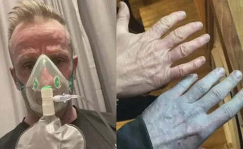 UK Man Wakes Up With Blue Skin, The Real Cause Leaves Doctors Laughing
