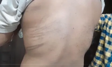 Ruling Party Supporters Attack on YSRCP Social Media Activist In Anaparthi