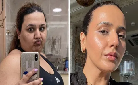 Weight Loss Helped This Dubai Woman Reverse PCOS to skin health