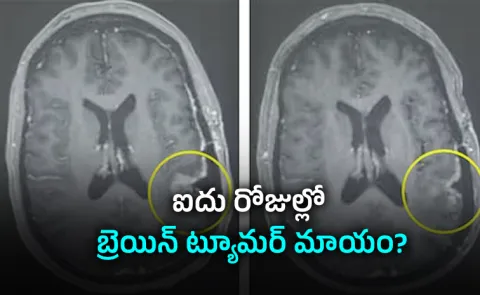 New cancer drug made brain tumour almost disappear in 5 days