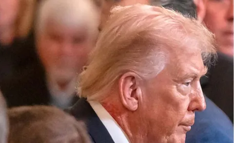 Trumps Neck Redness From Skin Cream: What It Means And What Happen
