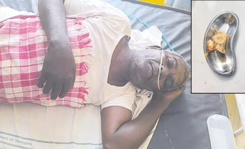 Chicken Bone Stuck in Throat Removed Safely