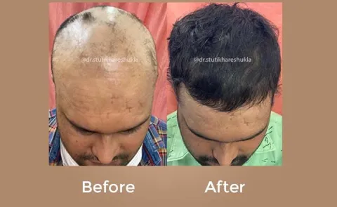 Dr Stuti Khare Shukla: Indias Hair Growth Queen