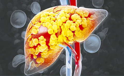 Liver Disease: excess fat builds up in liver cells