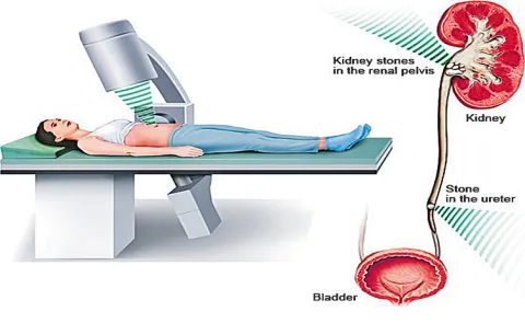 Modern medical procedure to Removal of kidney stones