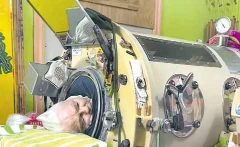Last American polio survivor in an iron lung dies at 78