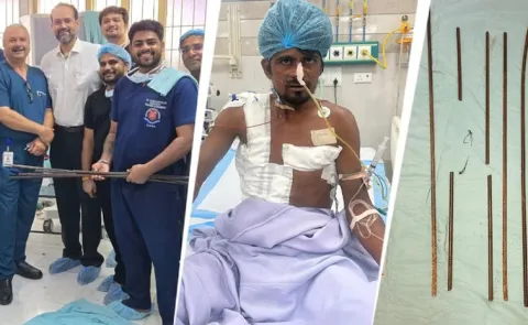 Doctors at KGMU Save Worker Impaled by Four Iron Rods
