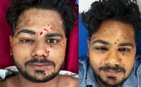 Pellet Guns Used on Student Protesters in Delhi Lives Altered by Severe Injuries