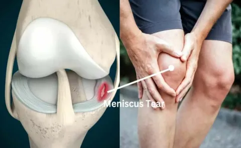 Torn Meniscus: Causes Symptoms Treatment And Prevention