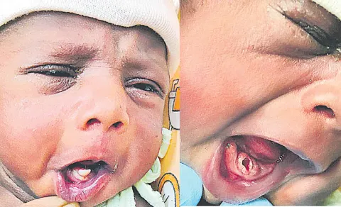 newborn born with tooth doctors remove it to help feeding