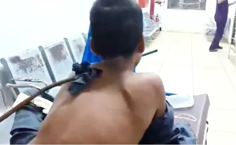 A 3 foot iron rod pierced through the neck and passed through the mouth12