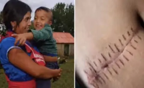 this woman performed a c section on herself and saved her babys life