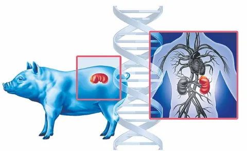 Transplantation of genetically modified pig kidney into a human