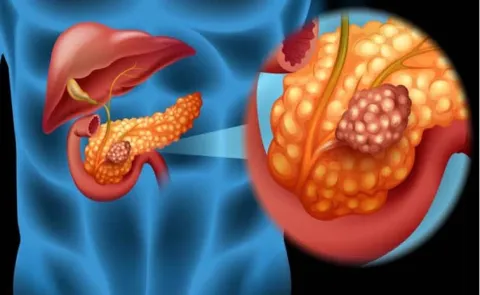 Health Tips: Pancreatic Cancer: Symptoms Causes And Treatment
