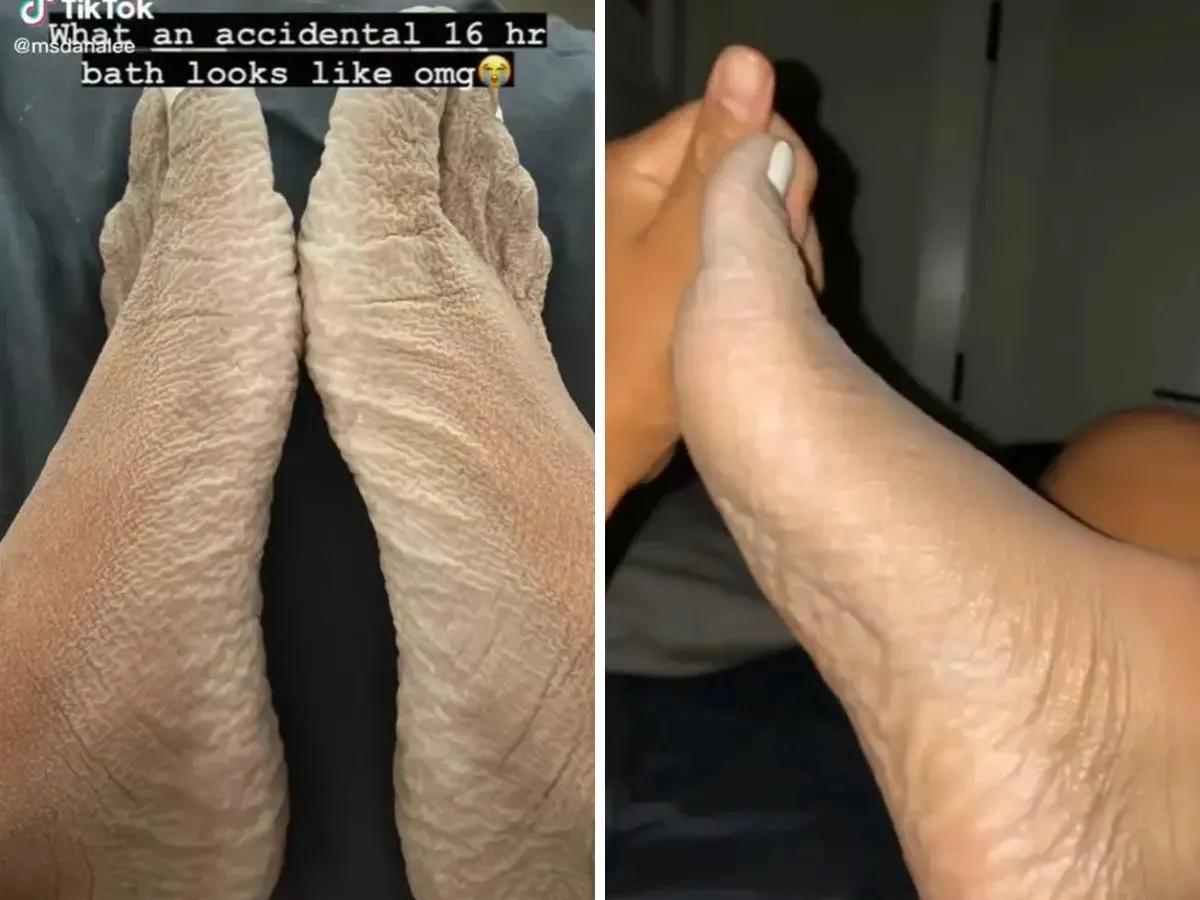 Woman Reveals What Happened to Her Feet After 16 Hour Bath - Sakshi