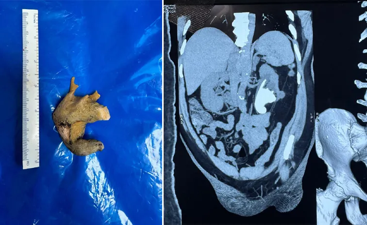 AINU Doctors Remove staghorn stone From Man Kidney