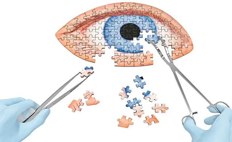 Precautions To Be Taken For Cataract Related Eye Problem Sakshi Plus News