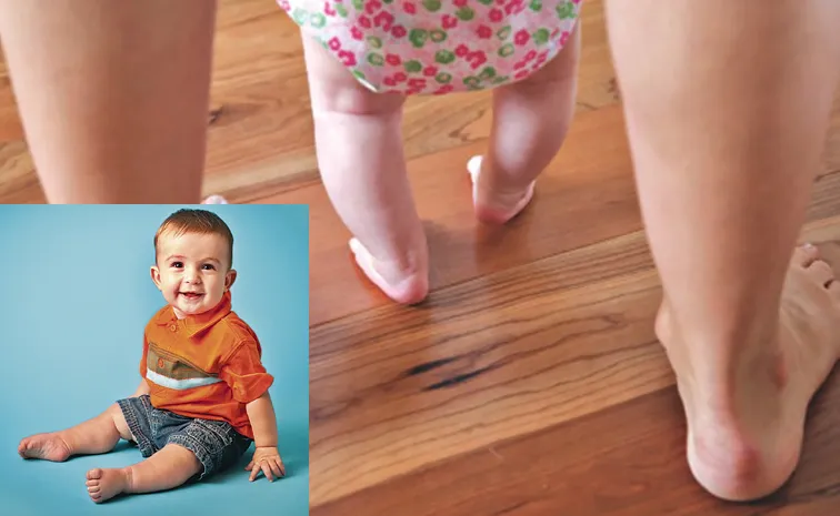Know the main cause of bow legs in Babies and treat it well