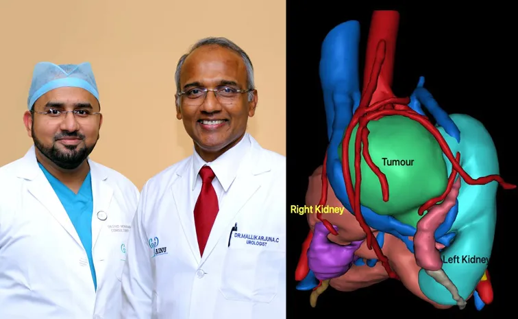 Pancake Kidney Problem: AINU Doctors Successfully Removes Tumor